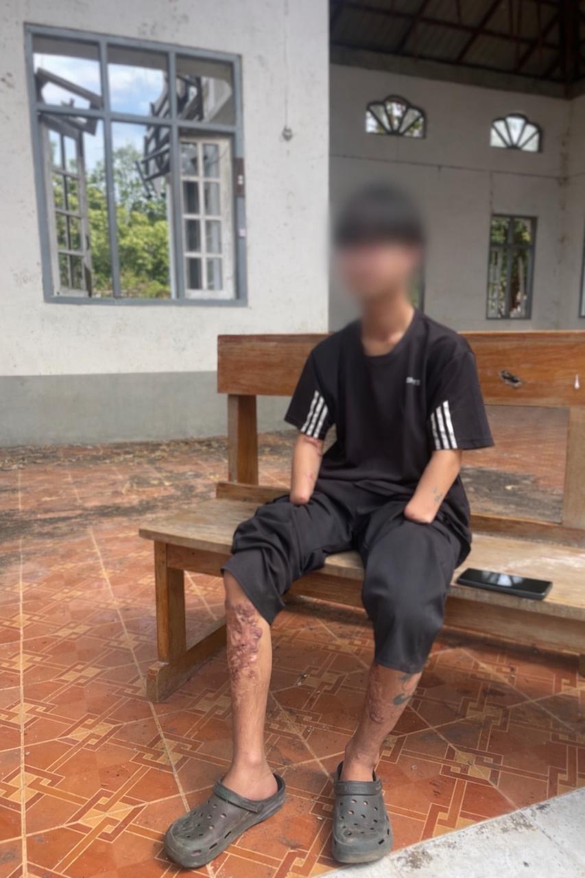 Young man with blurred face seated on a wooden bench after severe landmine injuries.